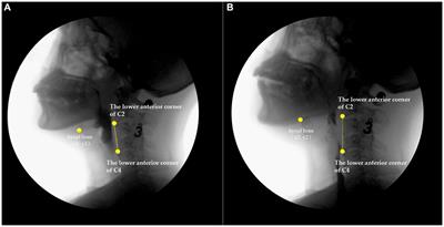 Findings of a videofluoroscopic swallowing study in patients with dysphagia